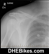 Click on the image for more info and a larger downhill mountain biking injury picture